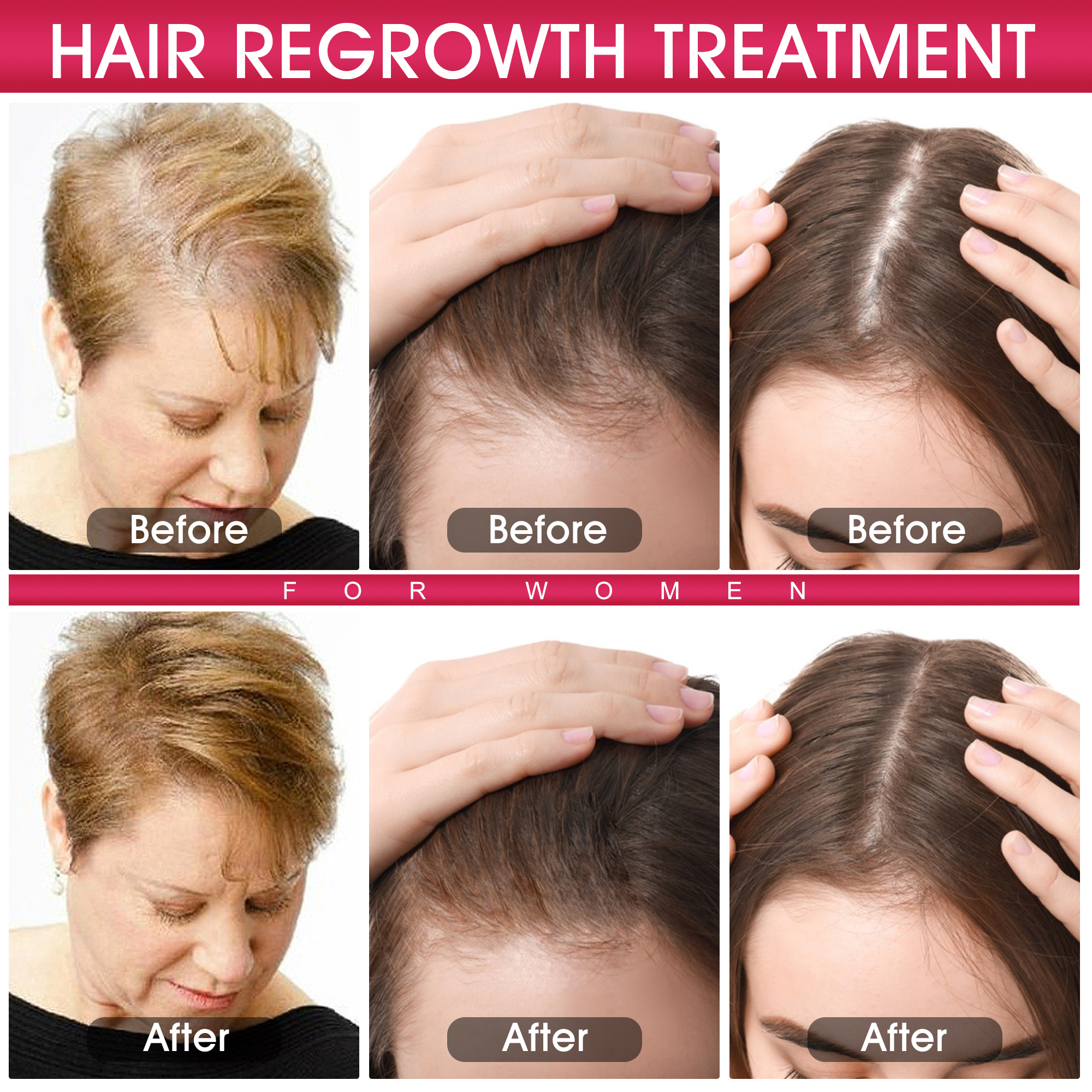 Hair fall and its treatment. | Ability India